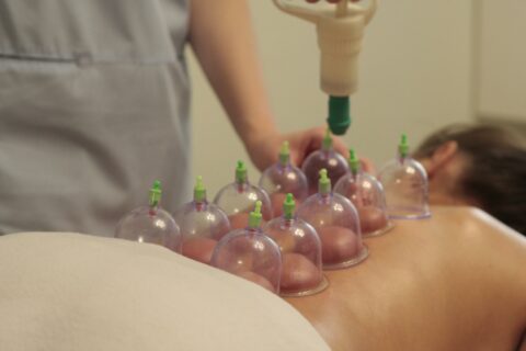 cupping